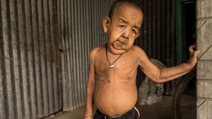 Boy looks like an old man and can't go to school because of rare condition