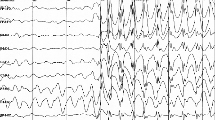 New developed technique could revolutionize surgical treatment of epilepsy