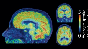 Scientists see chemical tagging in live brains