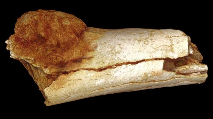 Oldest evidence of cancer in human family tree found