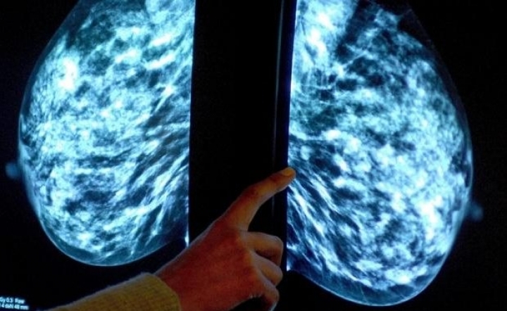 Biggest ever study shows Hormone Replacemnt Therapy triples risk of breast cancer