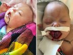 Baby girl is all smiles after being born with adult size tongue