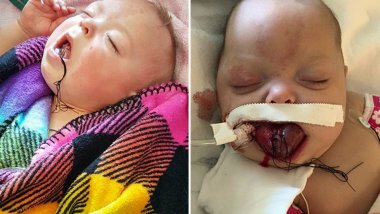 Baby girl is all smiles after being born with adult size tongue