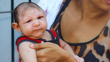 Zika virus causes not only microcephaly. Other illnesses are appalling, too  