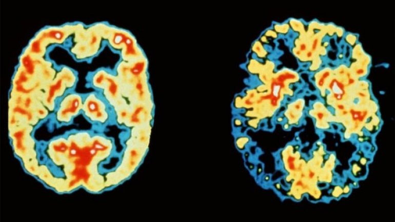 Dementia now leading cause of death