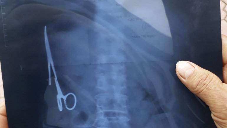 Man has scissors removed from inside him after 18-year stomach ache