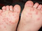 What to know about Coxsackievirus - summer sickness?