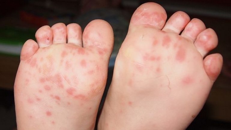 What to know about Coxsackievirus - summer sickness?