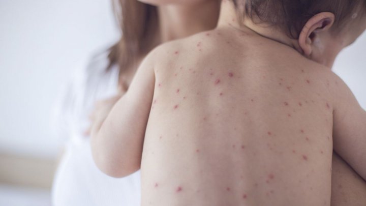 Alarming! Number of people infected of measles reached 105