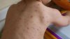 More people from Ceadir-Lunga were not enrolled in school. Parents refused to vaccinate them against measles