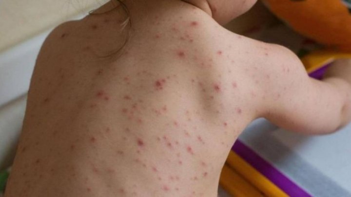 More people from Ceadir-Lunga were not enrolled in school. Parents refused to vaccinate them against measles