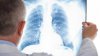 TUBERCULOSIS COMBAT: Dozens of people have had free lung screening