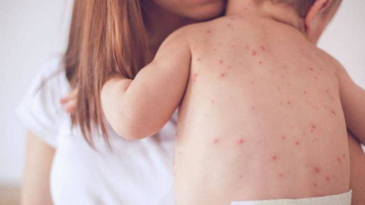 Two more cases of measles including a child recorded in Moldova 