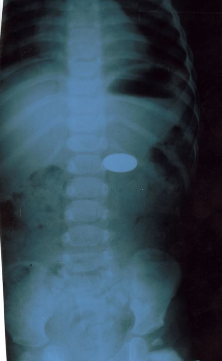 A two year old child from the Capital arrived at the hospital. What doctors took from her STOMACH