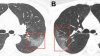 Doctors release chest scans of Wuhan coronavirus patient 