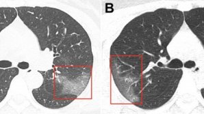 Doctors release chest scans of Wuhan coronavirus patient 