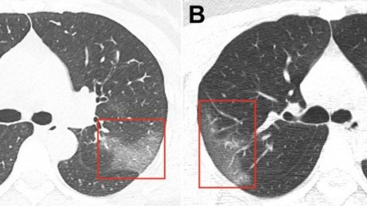 Doctors release chest scans of Wuhan coronavirus patient 