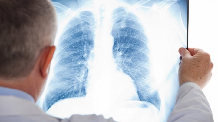 Five people including a child from Chisinau kindergarten no 203 diagnosed with TUBERCULOSIS