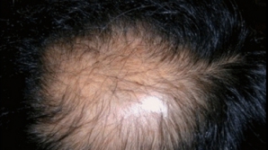 Calviţia precoce este un posibil indiciu pentru depistarea cancerului la prostată