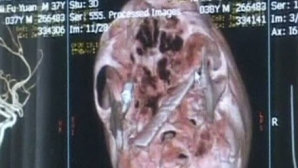 Şocant: Un chinez a trăit patru ani cu o lamă de cuţit în craniu 