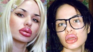 Tânăra cu cele mai mari buze din lume