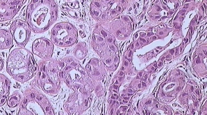 Cercetătorii coreeni au descoperit o metodă ingenioasă de distrugere a cancerului 