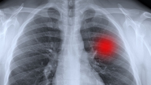 Revoluţie în oncologie: Dispozitivul care diagnostichează cancerul în DOAR 20 de minute