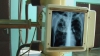 Radiografie cu tehnică de muzeu. Mai mult de jumătate din aparatele roentgen din spitalele Moldovei sunt din perioada sovietică 