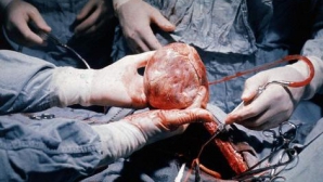 Moldovenii care au nevoie de transplant de inimă trebuie să mai aştepte. Nu sunt bani şi specialişti