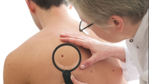Alarmant! În ultimii ani s-a dublat numărul moldovenilor bolnavi de cancer de piele 