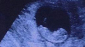 TE VOR TRECE FIORII. Ecografii în care apar "chipuri" inexplicabile lângă pruncii nenăscuţi