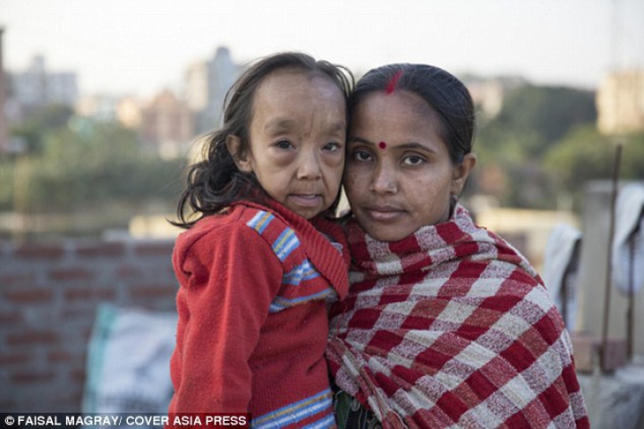 Nu s-au născut ca şi noi. Doi copii din India suferă de o boală genetică foarte rară (FOTO)