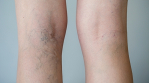 Varicele, DUŞMAN al picioarelor! Simptomele pe care NU TREBUIE să le ignori