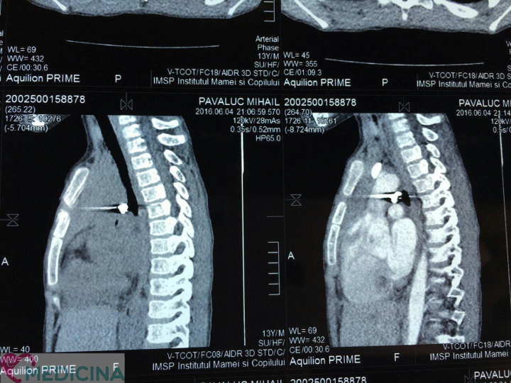 GROAZNIC! Un copil din Hânceşti, împușcat accidental cu o armă pneumatică. CUM A FOST SALVAT