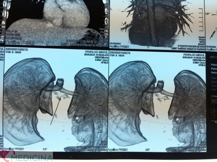 GROAZNIC! Un copil din Hânceşti, împușcat accidental cu o armă pneumatică. CUM A FOST SALVAT