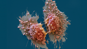 Simptome ale CANCERULUI pe care NU trebuie să le eviţi