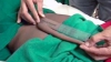 Neurochirurgii indieni au tăiat cea mai lungă coadă a unui om (VIDEO CU IMPACT EMOŢIONAL)