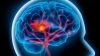 Accidentul vascular cerebral poate fi PREVENIT! Măsurile întreprinse de o echipă de medici de moldoveni