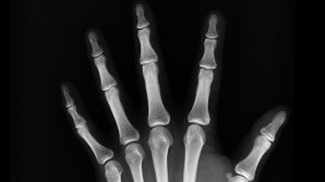 TREBUIE SĂ ŞTII! Alimentul pe care îl consumi zilnic şi îţi distruge oasele