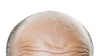 #LifeStyle. Implantul de păr, soluţia pentru bărbaţii care suferă de alopecie