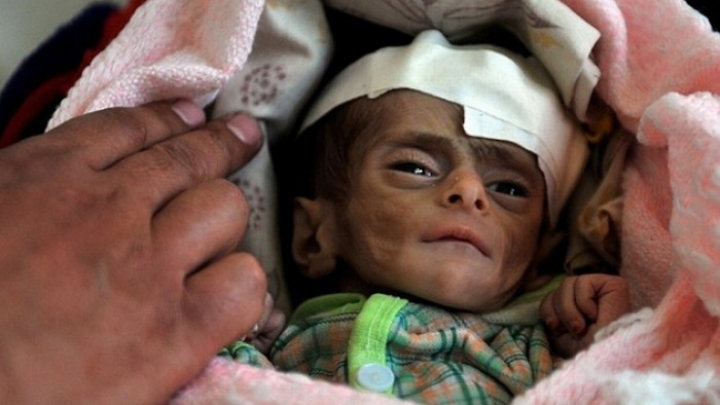 1,1 miliarde de euro ca ajutor umanitar pentru Yemen. Țara unde un copil sub 5 ani moare la fiecare 10 minute
