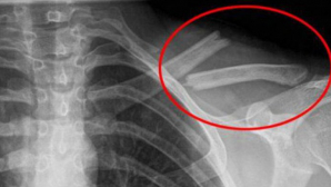 O bei în fiecare zi! OTRAVA care îţi distruge oasele, iar tu nici nu bănuiai