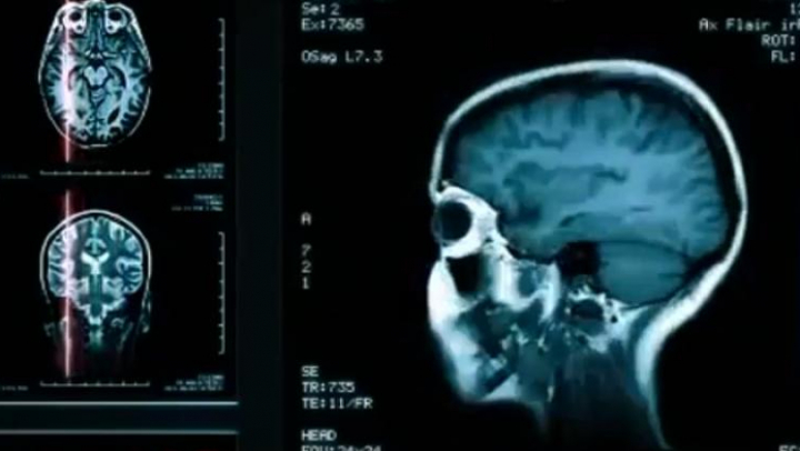 STUDIU: Care este primul semn de Alzheimer la o persoană tânără