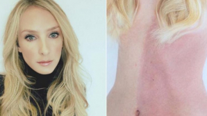 S-a născut cu pielea în două culori. Femeia are și două grupe de sânge (FOTO)