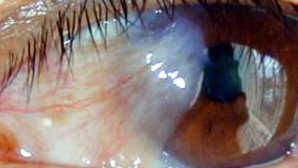 INCREDIBIL! Ce au găsit chirurgii în ochii unei bătrâne (FOTO)