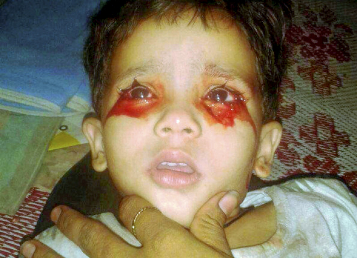 INCREDIBIL! O fetiță plânge cu lacrimi de sânge