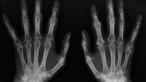 ÎNGROZITOR! Ce se întâmplă cu oasele locuitorilor din orașele poluate