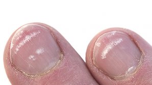 ATENŢIE! Ai grijă la petele albe de pe unghii. Pot ascunde o boală gravă 