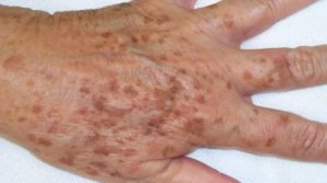 Bine de știut! Scapă de petele de bătrâneţe de pe mâini, gât şi faţă cu acest remediu simplu