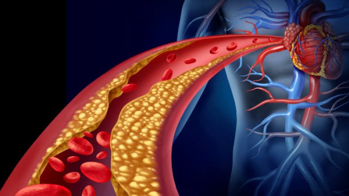 ESTE BINE SĂ ŞTII! Ce nu-ţi spune medicul despre colesterol. Motivul pentru care nu este bine să iei medicamente